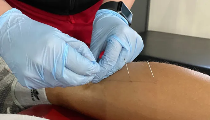 Dry needling treatment session at Avila Physical Therapy