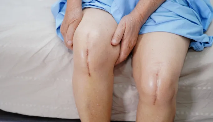Patient's knees showing surgical scars after knee replacement